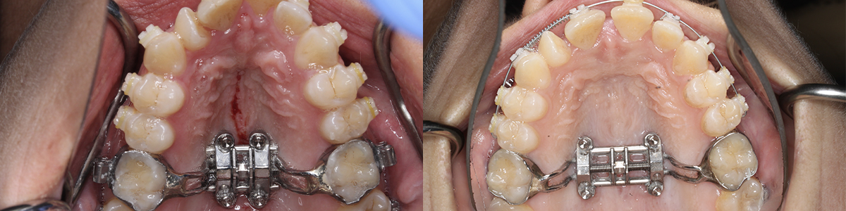 Maxillaire skeletexpansie (MSE); Miniscrew Assisted Rapid Palatal Expansion (MARPE)￼ | OMFS in het binnenland